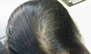 秃如其来：当'面子'经济遇上脱发救星！ 